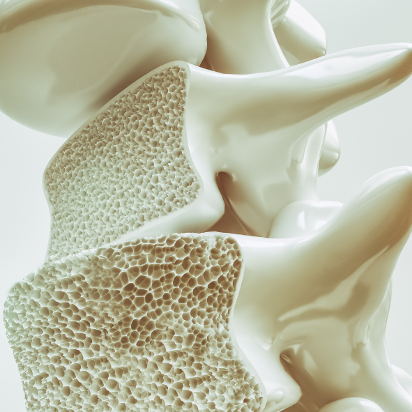 Osteoporosis Support